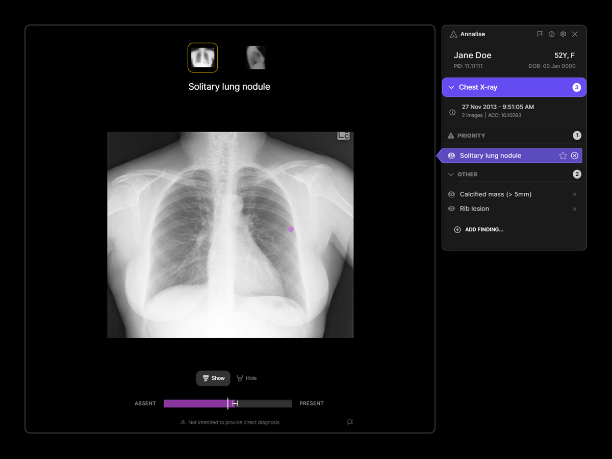 Clinical-CXR-ROW-lung-nodule-over.jpg